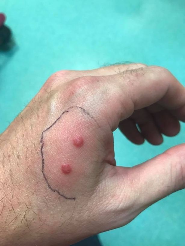 It-felt-like-my-hand-was-on-fire-snakebite-turned-dads-hand-purple-after-he-found-15-serpents-in.jpg